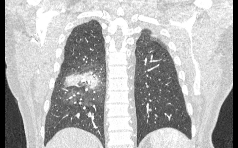 File:Acute pulmonary embolism with pulmonary infarcts (Radiopaedia 77688-89908 Coronal lung window 78).jpg
