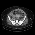 Acute pyelonephritis (Radiopaedia 25657-25837 Axial renal parenchymal phase 62).jpg
