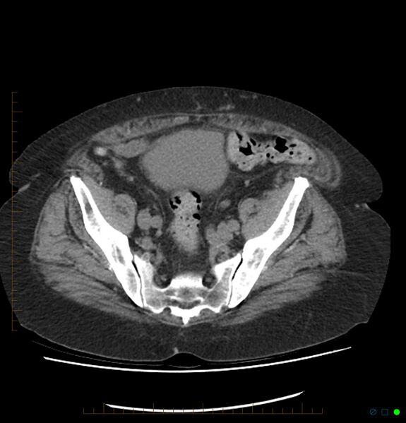File:Acute renal failure post IV contrast injection- CT findings (Radiopaedia 47815-52557 Axial non-contrast 65).jpg
