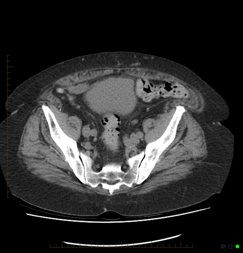Acute renal failure post IV contrast injection- CT findings (Radiopaedia 47815-52557 Axial non-contrast 65).jpg