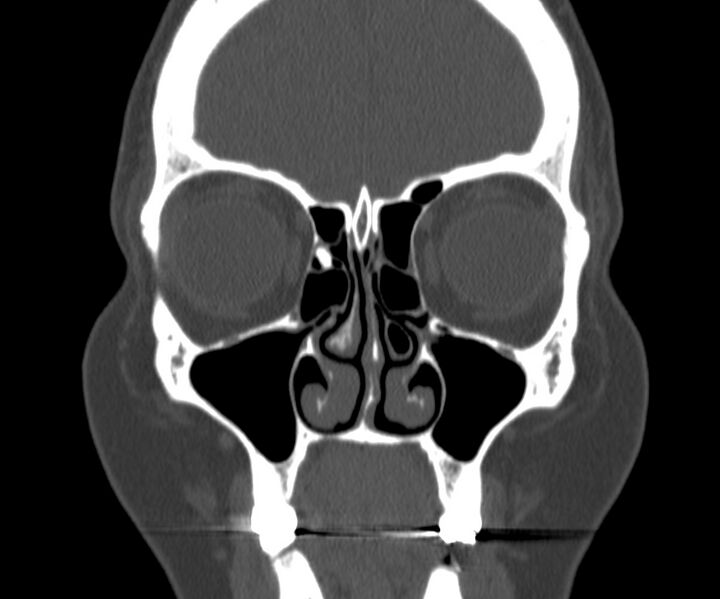 File:Acute sinusitis (Radiopaedia 22419-22455 Coronal bone window 13).jpg