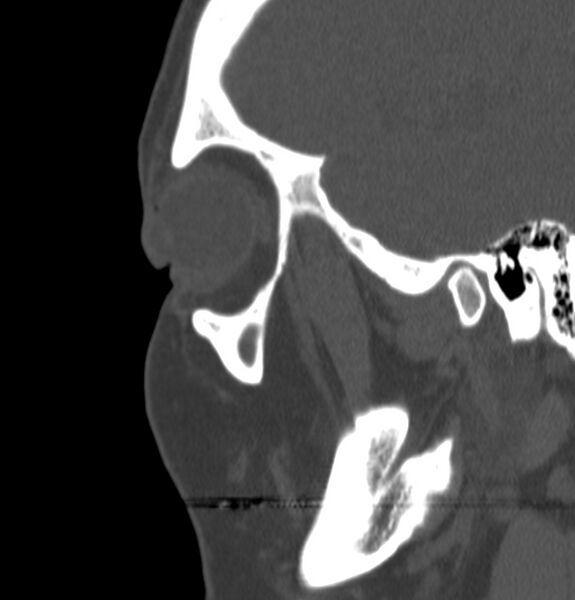 File:Acute sinusitis (Radiopaedia 22419-22455 Sagittal non-contrast 24).jpg