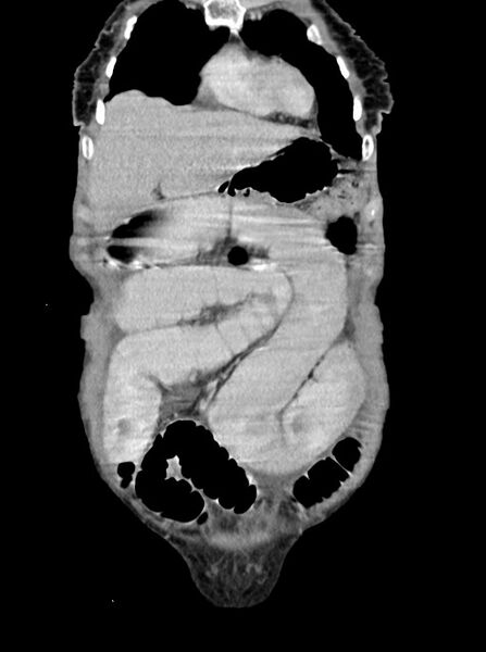 File:Acute small bowel (ileal) volvulus (Radiopaedia 71740-82139 Coronal C+ portal venous phase 23).jpg