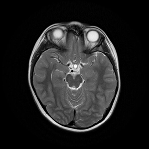 File:Adamantinomatous craniopharyngioma (Radiopaedia 77407-89529 Axial T2 10).jpg