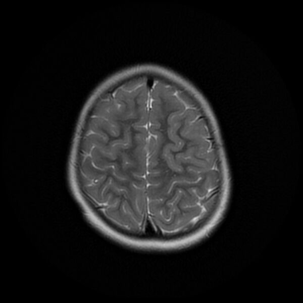 File:Adamantinomatous craniopharyngioma (Radiopaedia 77407-89529 Axial T2 21).jpg