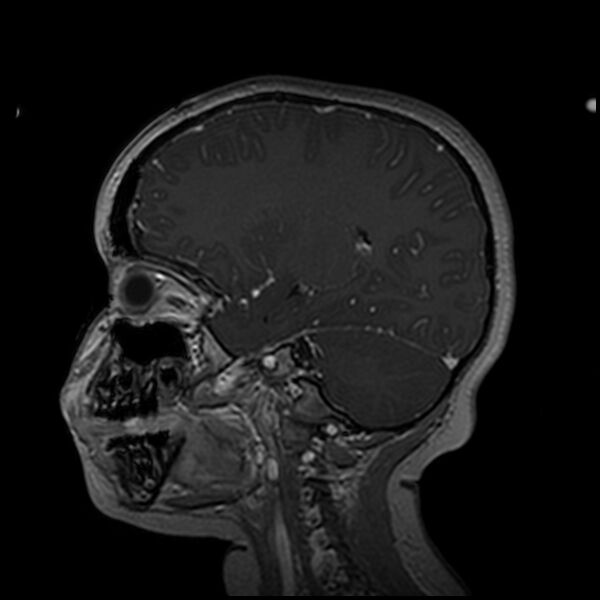 File:Adamantinomatous craniopharyngioma (Radiopaedia 77407-89529 H 78).jpg