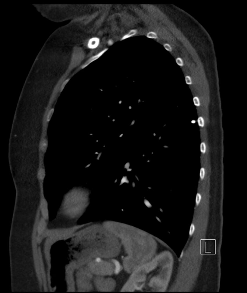 Adenocarcinoma of the lung (Radiopaedia 44205-47803 Sagittal C+ portal venous phase 17).jpg