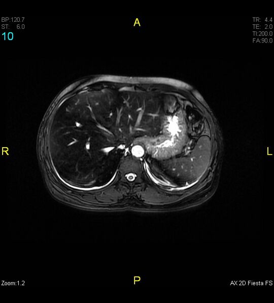 File:Adenomyosis (Radiopaedia 43504-46889 Axial 2D FIESTA 10).jpg