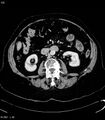 Adrenal myelolipoma (Radiopaedia 6765-7960 Axial C+ arterial phase 18).jpg