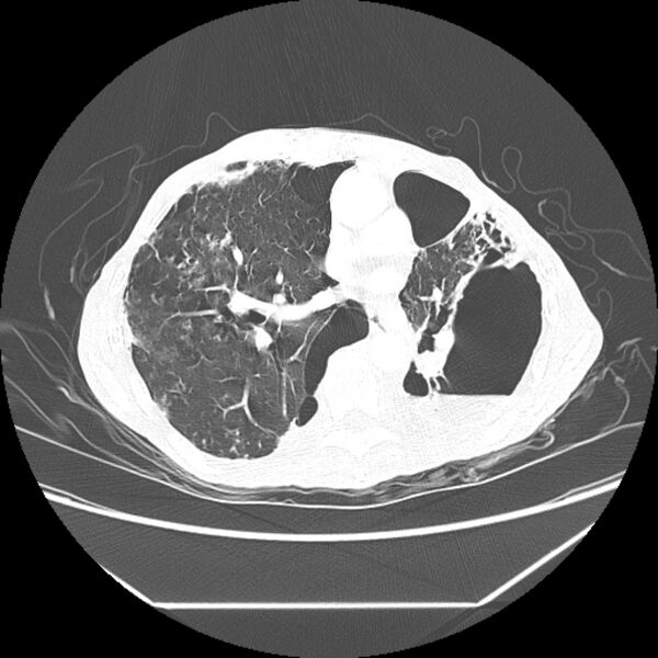 File:Advanced pulmonary tuberculosis (Radiopaedia 8599-9431 Axial lung window 27).jpg