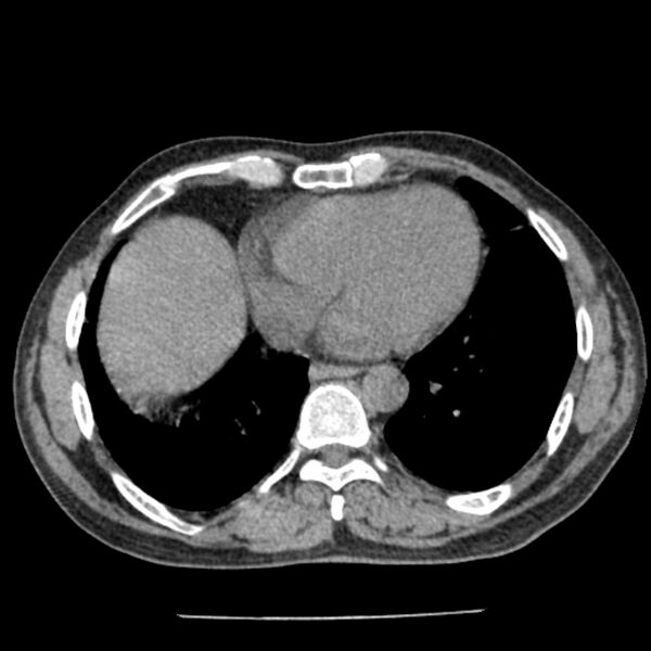 File:Airway foreign body in adult (Radiopaedia 85907-101779 Axial liver window 131).jpg