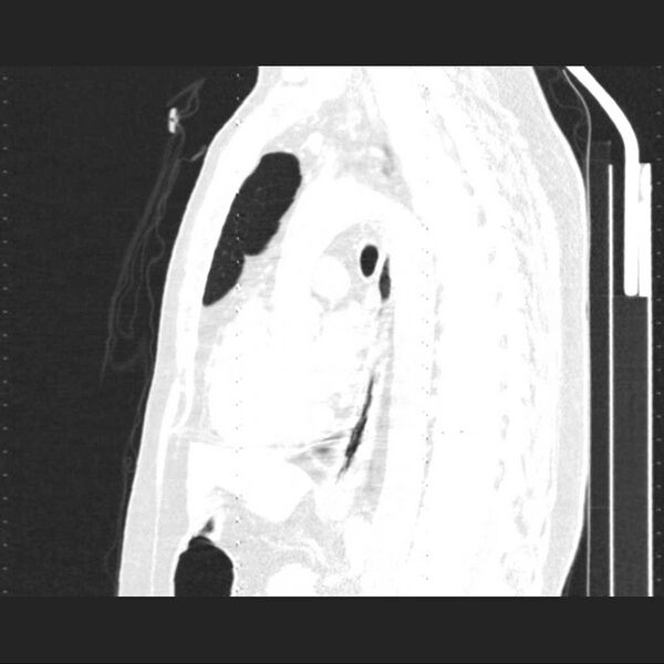 File:Allergic bronchopulmonary aspergillosis (Radiopaedia 21386-21320 Sagittal lung window 9).jpg