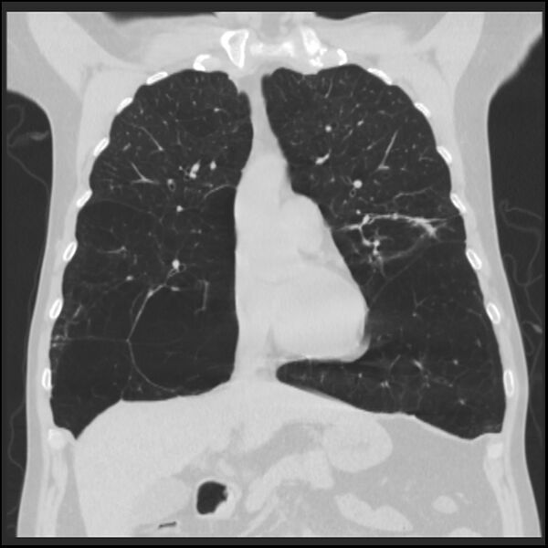 File:Alpha-1-antitrypsin deficiency (Radiopaedia 40993-43722 Coronal lung window 35).jpg