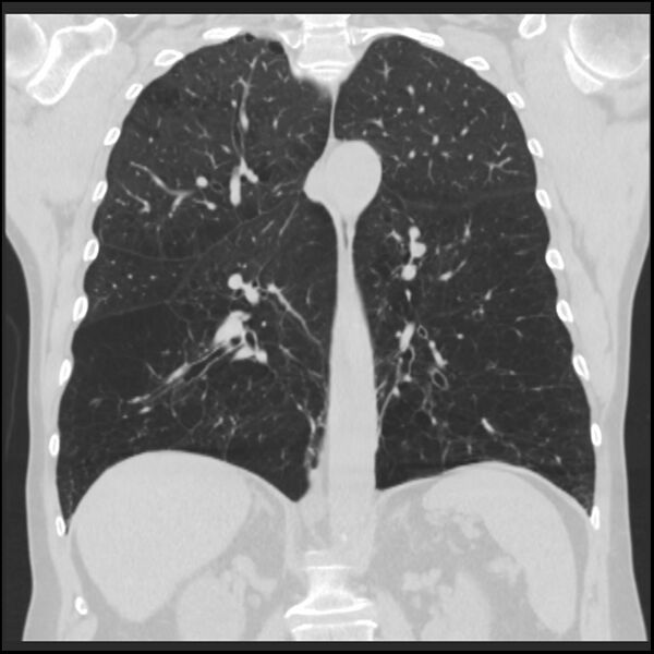 File:Alpha-1-antitrypsin deficiency (Radiopaedia 40993-43722 Coronal lung window 64).jpg