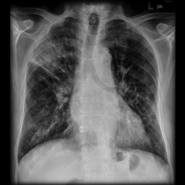 File:Amiodarone lung (Radiopaedia 6539-7850 Frontal 1).jpg