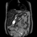 Ampullary tumor (Radiopaedia 27294-27479 Coronal T2 8).jpg