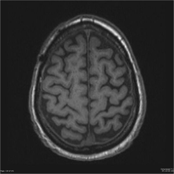 File:Anaplastic meningioma with recurrence (Radiopaedia 34452-35788 Axial T1 116).jpg