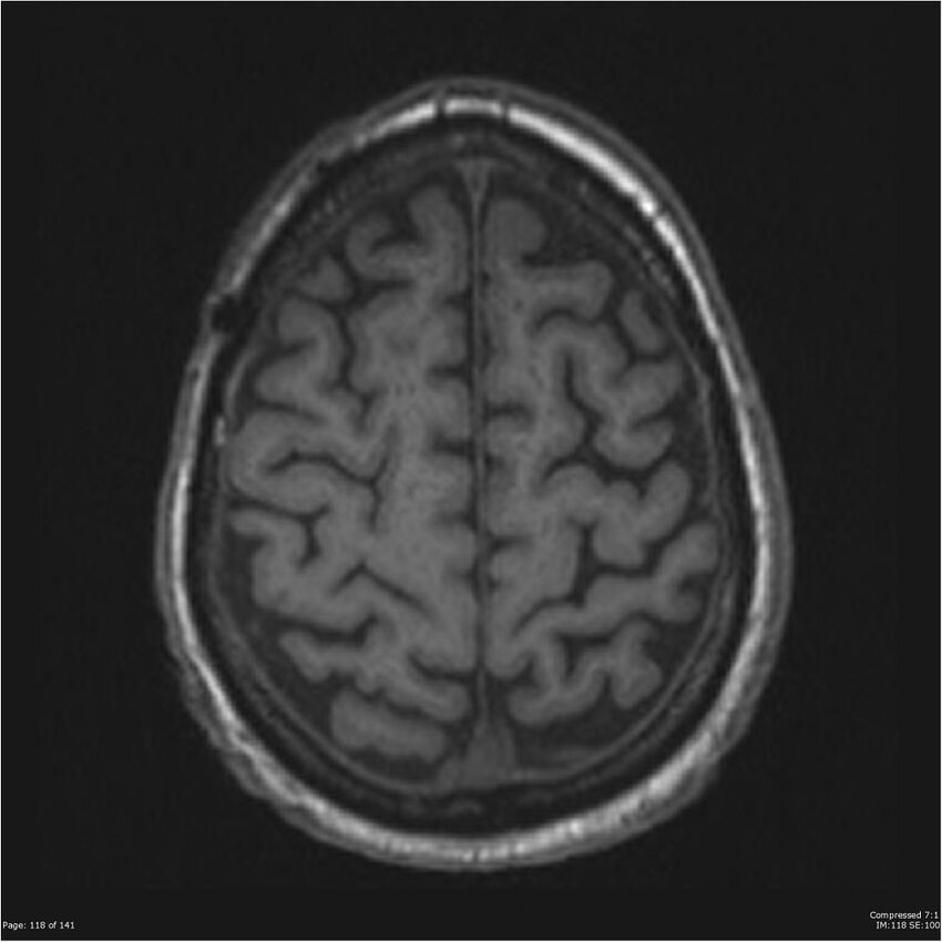 Anaplastic meningioma with recurrence (Radiopaedia 34452-35788 Axial T1 116).jpg