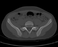 Aneurysmal bone cyst of ischium (Radiopaedia 25957-26094 Axial bone window 17).png
