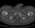 Aneurysmal bone cyst of ischium (Radiopaedia 25957-26094 Axial bone window 75).png