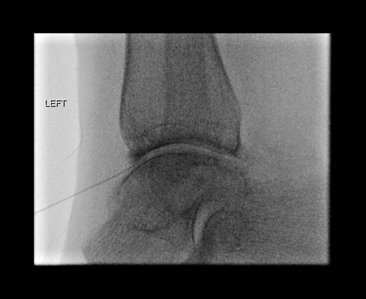 File:Ankle joint injection (fluoroscopic guided) (Radiopaedia 87288-103578 B 1).jpg