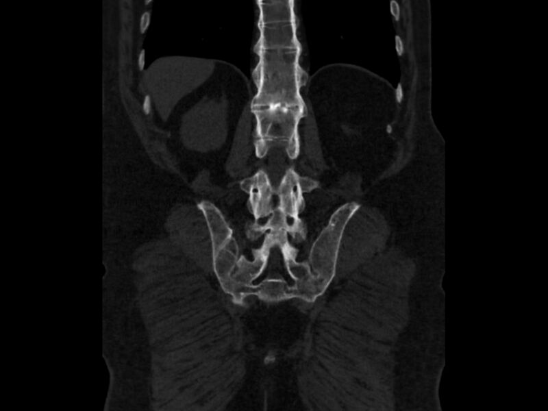 File:Ankylosing spondylitis (Radiopaedia 44609-48357 Coronal bone window 76).jpg