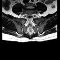 Ankylosing spondylitis with zygapophyseal arthritis (Radiopaedia 38433-40517 C 10).jpg