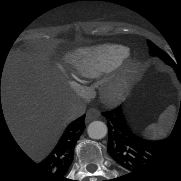File:Anomalous origin of left circumflex artery from right coronary sinus (Radiopaedia 72563-83117 A 7).jpg