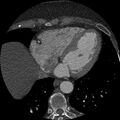 Anomalous origin of left circumflex artery from right coronary sinus (Radiopaedia 72563-83117 B 118).jpg