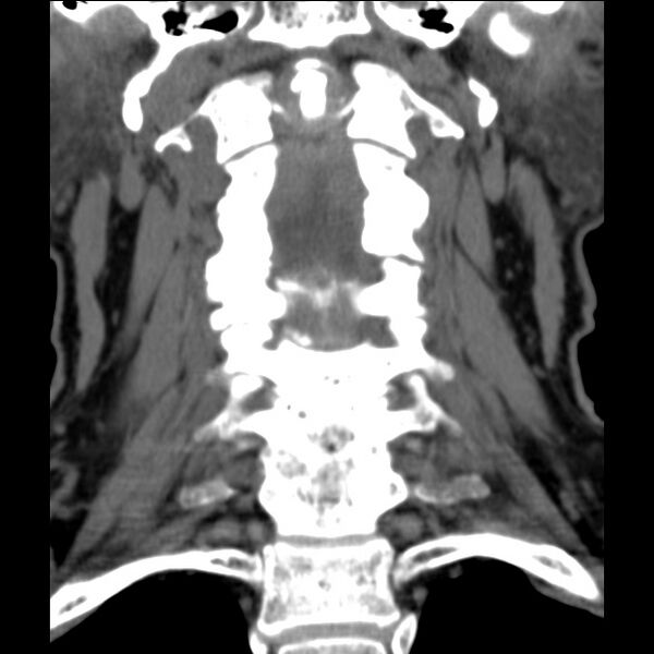 File:Anterior cervical postdiscectomy arthrodesis (Radiopaedia 32678-33646 Coronal non-contrast 15).jpg