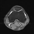 Anterior cruciate ligament full thickness tear (Radiopaedia 66268-75467 Axial PD fat sat 11).jpg