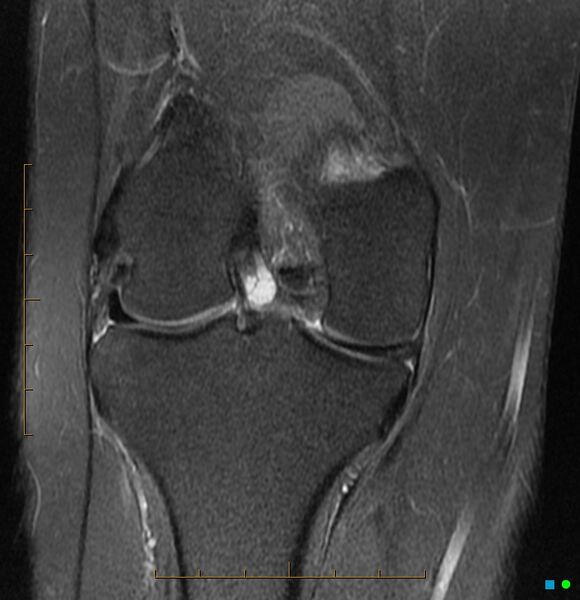 File:Anterior cruciate ligament ganglion cyst (Radiopaedia 3582-6491 Coronal PD fat sat 3).jpg