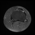 Anterior cruciate ligament tear, Wrisberg rip and bucket-handle tear of medial meniscus (Radiopaedia 75872-87266 Axial PD fat sat 6).jpg