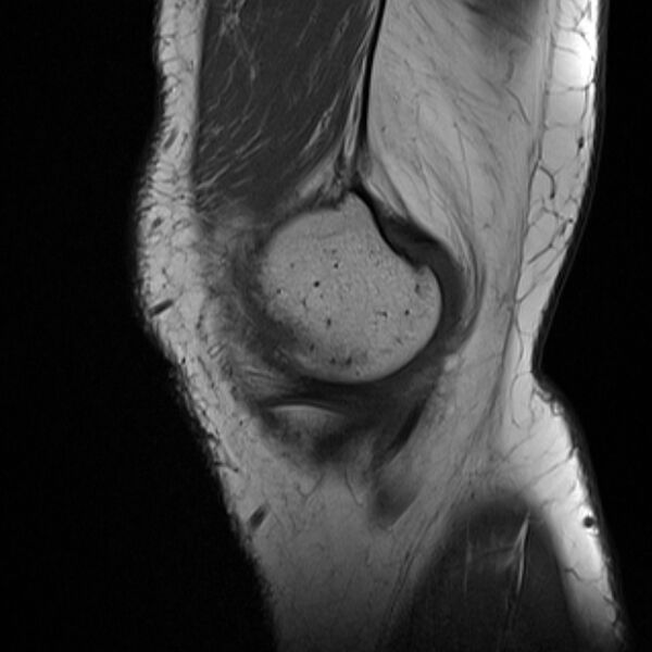 File:Anterior cruciate ligament tear - ramp lesion (Radiopaedia 71883-82322 Sagittal T1 22).jpg