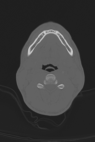 File:Anterior nasal spine fracture (Radiopaedia 46138-50494 Axial bone window 73).png