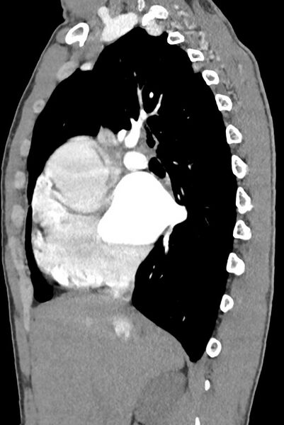 File:Aortic coarctation with aneurysm (Radiopaedia 74818-85828 B 63).jpg