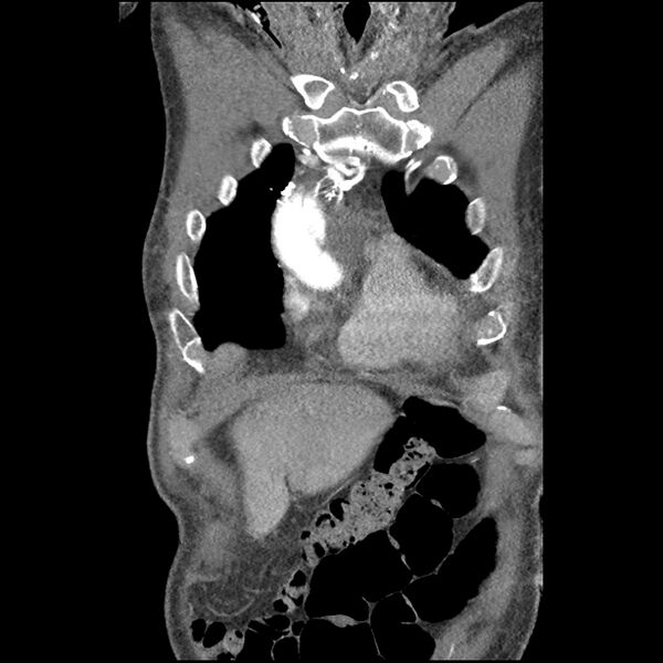 File:Aortic dissection - DeBakey Type I-Stanford A (Radiopaedia 79863-93115 B 8).jpg