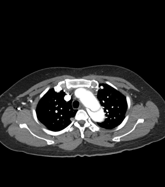 File:Aortic dissection with renal ischemia (Radiopaedia 76573-88338 A 12).jpg