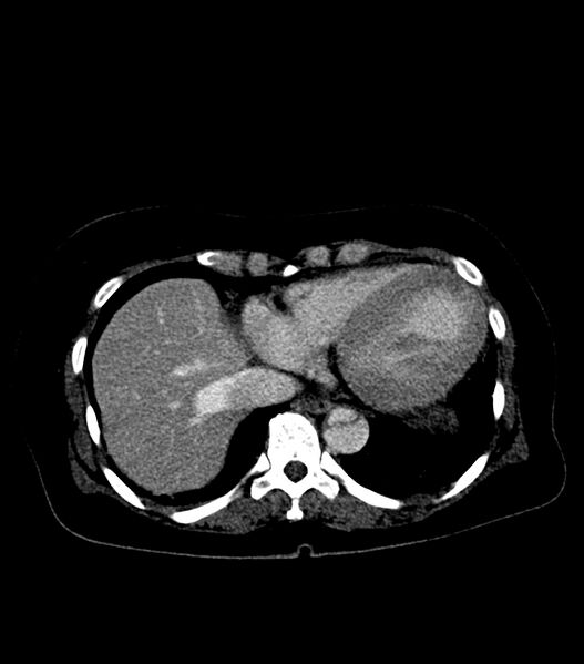 File:Aortic dissection with renal ischemia (Radiopaedia 76573-88338 B 20).jpg