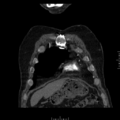 Aorto-coronary bypass graft aneurysms (Radiopaedia 40562-43157 B 5).png