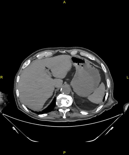 File:Aortoenteric fistula (Radiopaedia 84308-99603 Axial non-contrast 51).jpg