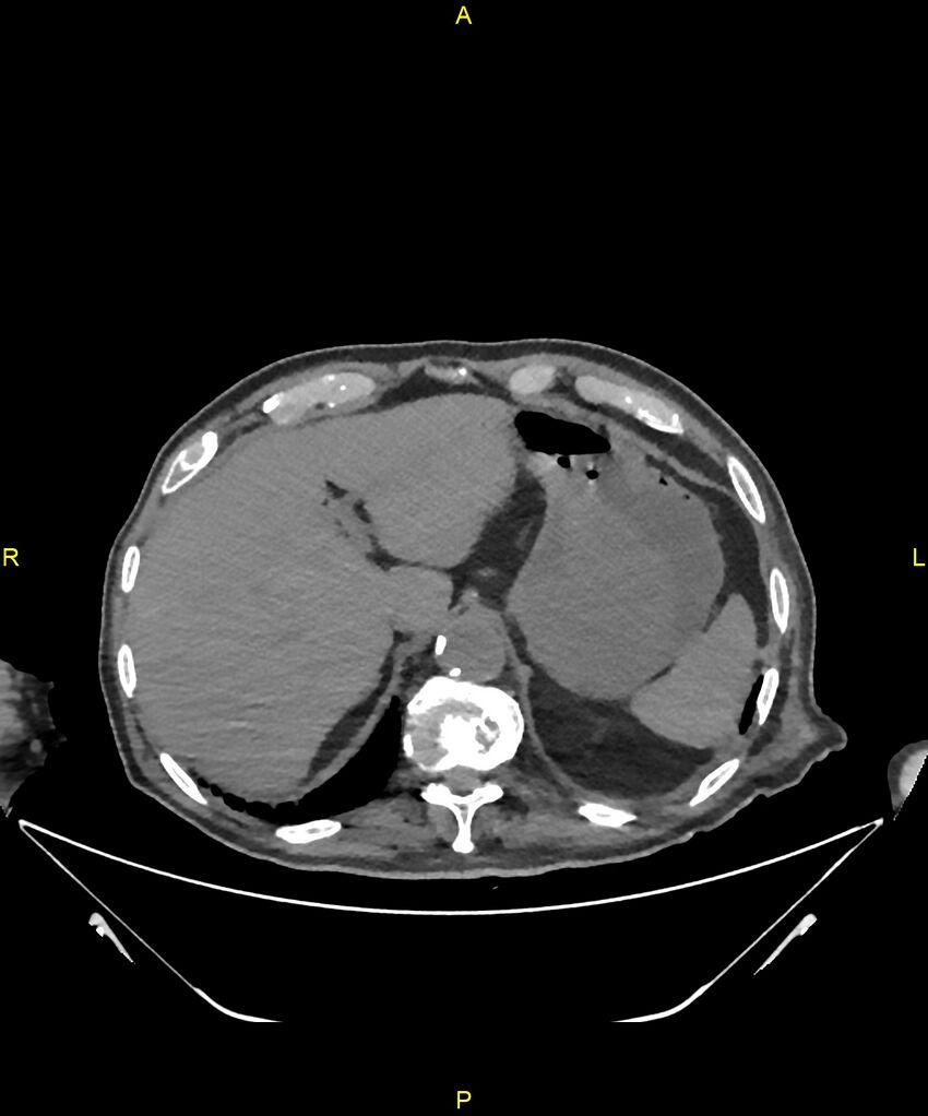 Aortoenteric fistula (Radiopaedia 84308-99603 Axial non-contrast 51).jpg