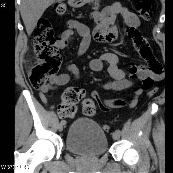 File:Appendicitis (Radiopaedia 12510-12733 Coronal non-contrast 5).jpg