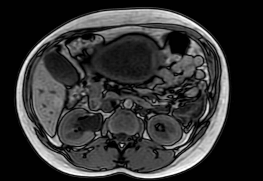 Appendicitis in gravida (MRI) (Radiopaedia 89433-106395 D 25).jpg
