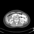 Appendicitis with minimal stranding but appendicolith (Radiopaedia 29035-29397 A 36).jpg