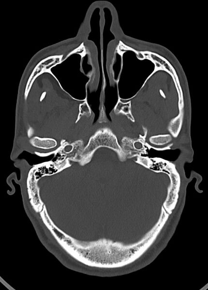 File:Arrow injury to the head (Radiopaedia 75266-86388 Axial bone window 50).jpg
