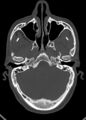 Arrow injury to the head (Radiopaedia 75266-86388 Axial bone window 50).jpg