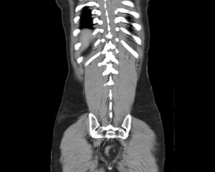 File:Arterial occlusive mesenteric ischemia (Radiopaedia 84641-100060 B 49).jpg