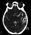 Arteriovenous malformation - cerebral (Radiopaedia 8172-14683 Figure 2 1).png