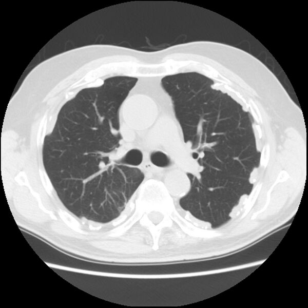 File:Asbestos-related pleural plaques (Radiopaedia 39069-41255 Axial lung window 30).jpg
